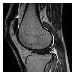 Resonancia Rodilla